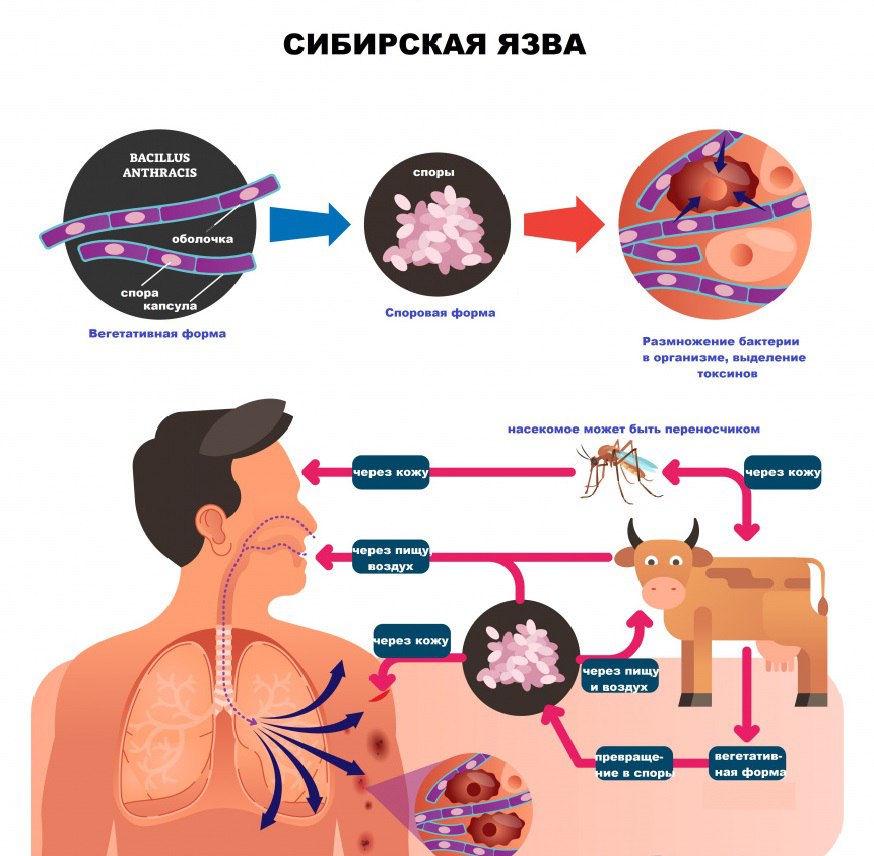 Сибирская язва.